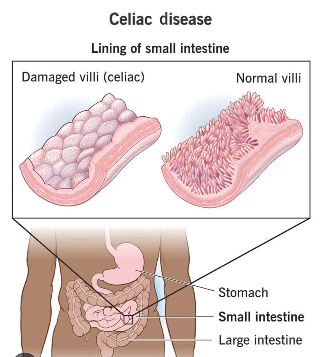 Newly Diagnosed with Celiac Disease? Start Here.